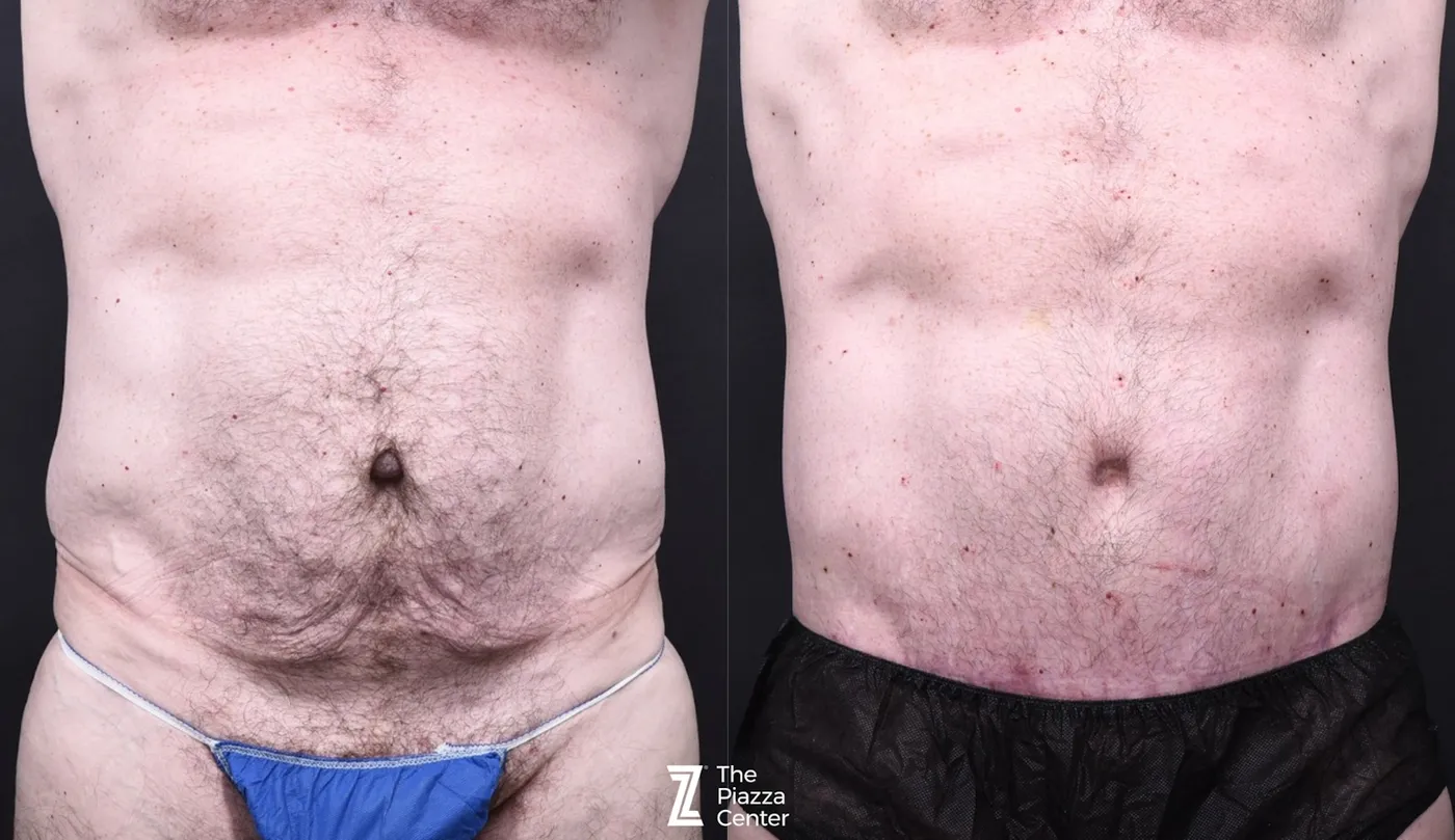 Austin Liposuction Before & After Gallery - Patient 294040 - Image 1 - The Piazza Center