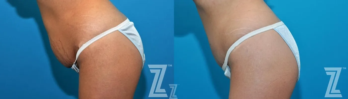 Austin 36 year old woman 1 year post op oblique flexion view mommy makeover - Austin Tx, The Piazza Center - The Piazza Center