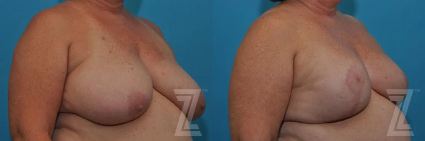 Austin Breast Reduction Before & After Gallery - Patient 132886617 - Image 4 - The Piazza Center