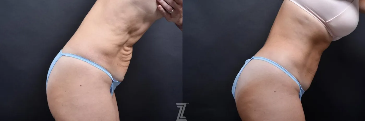 Austin Skin Pinch Before & After Gallery - Patient 132886939 - Image 5 - The Piazza Center