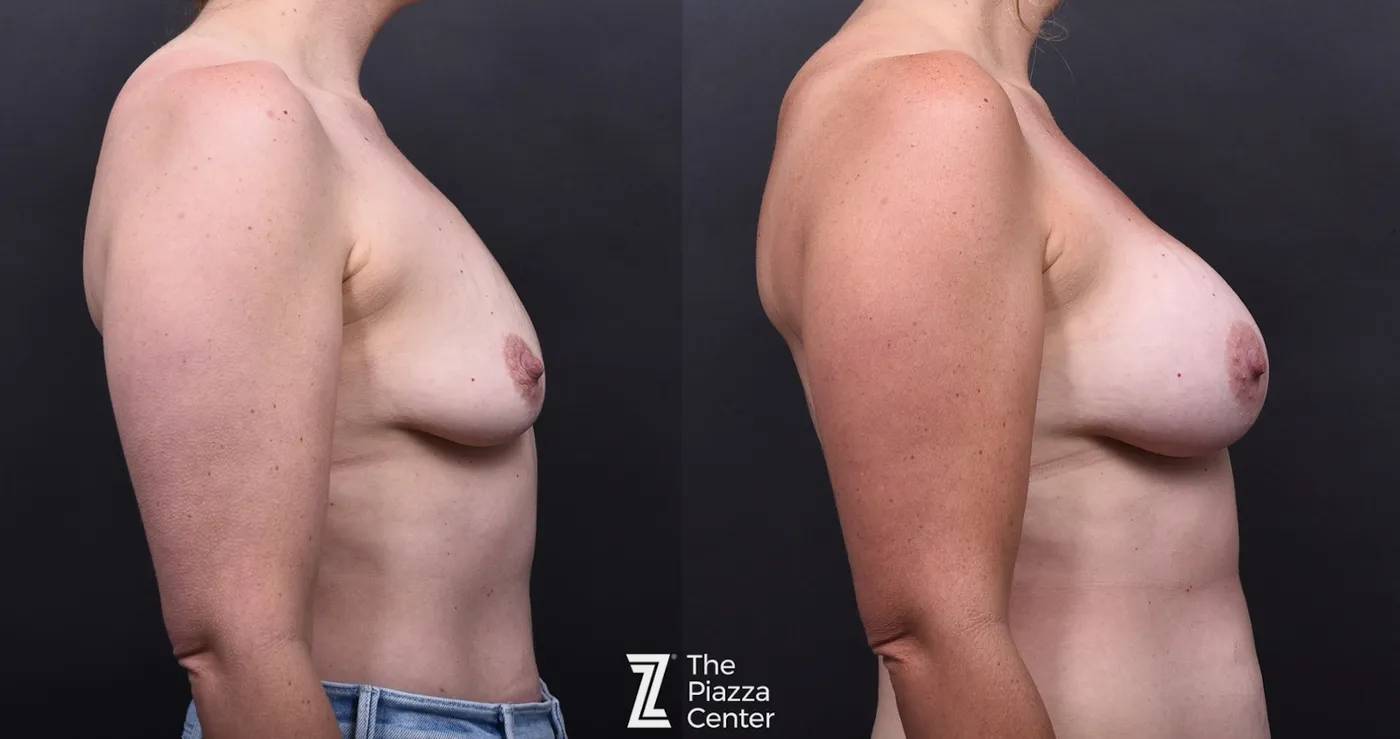 Austin Motiva Implants Before & After Gallery - Patient 261782 - Image 3 - The Piazza Center