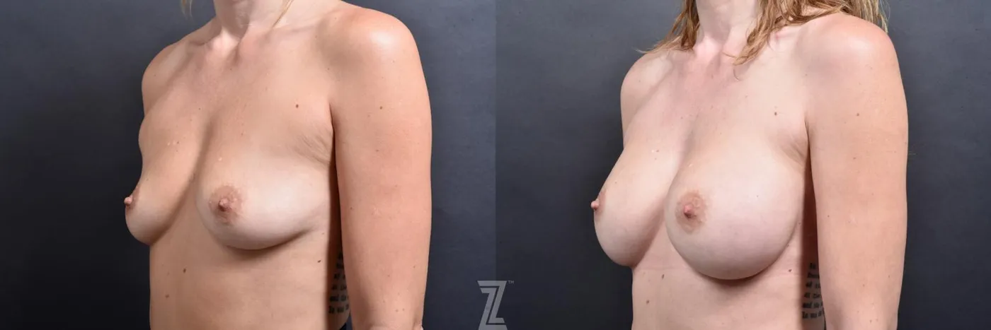 Austin oblique View before and after 1 year post op 39 year old woman with Silicone Implants with Cohesive Silicone Gel - The Piazza Center
