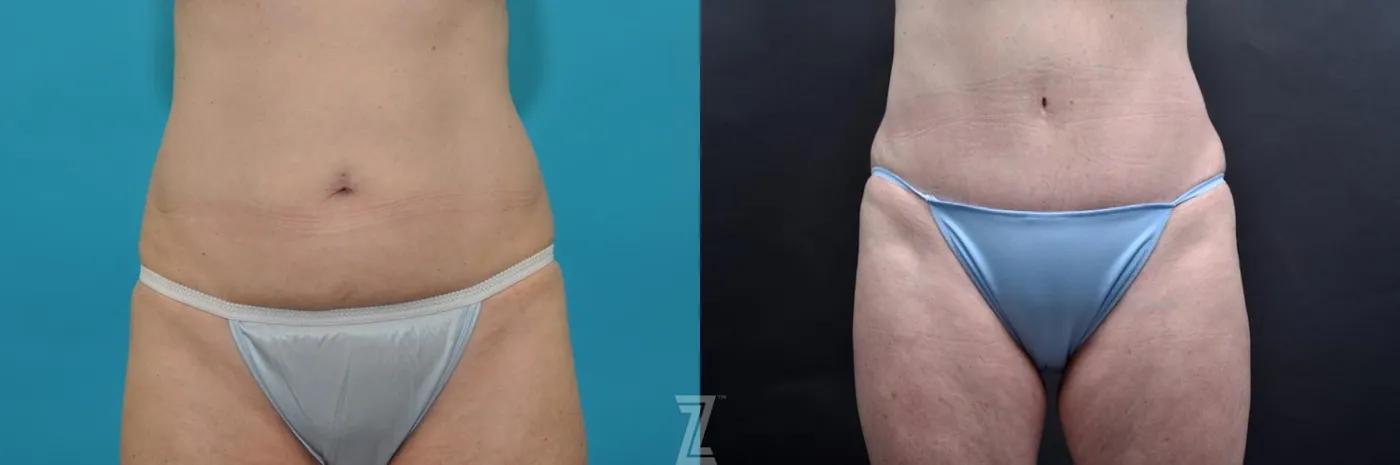 Austin Frontal abdominal view 7 year post op mommy makeover - The Piazza Center, Austin Tx - The Piazza Center
