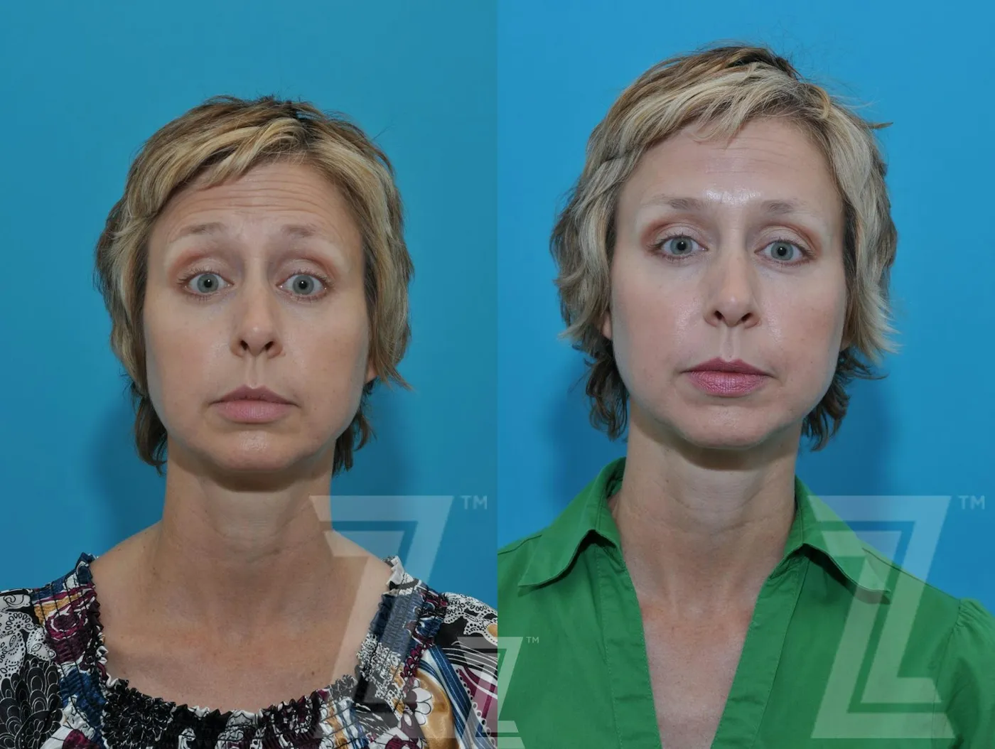 Austin Wrinkle Relaxers Before & After Gallery - Patient 132906319 - Image 3 - The Piazza Center