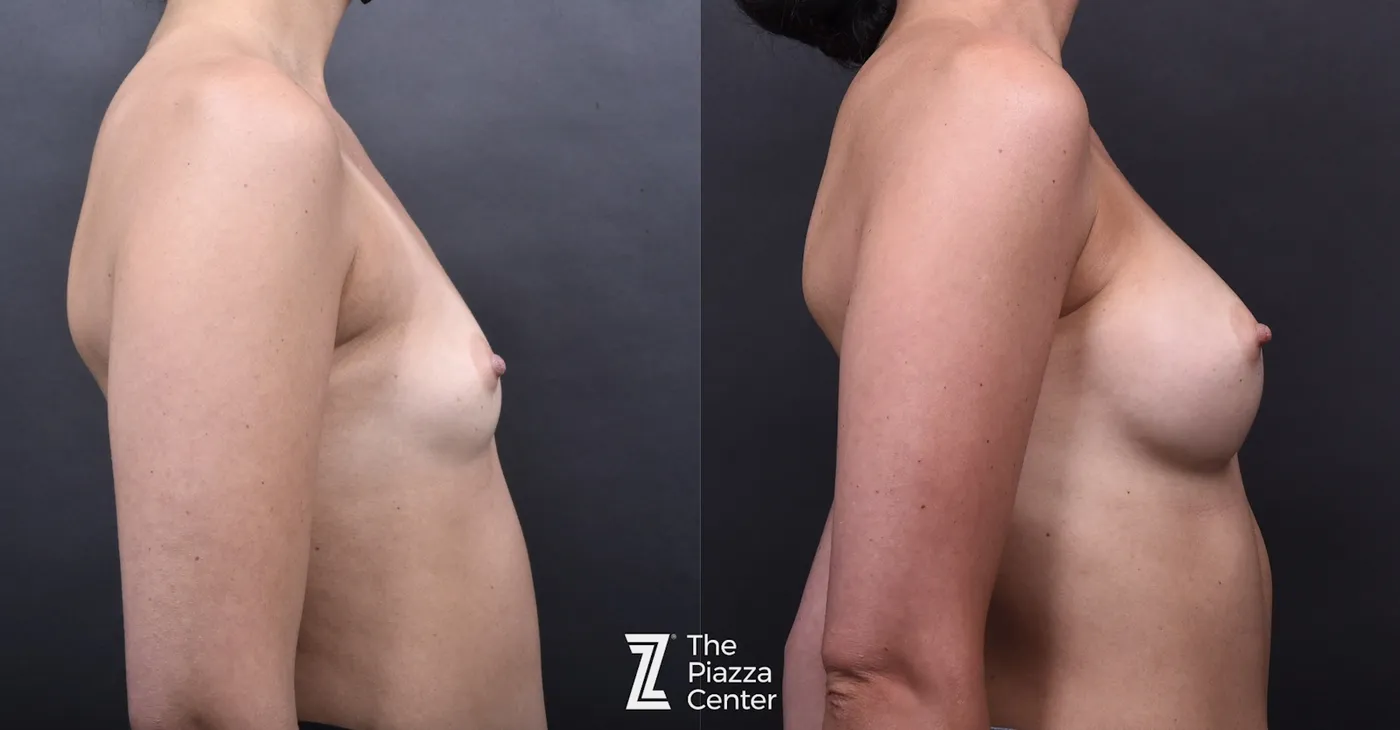 Austin Breast Augmentation Before & After Gallery - Patient 790705 - Image 3 - The Piazza Center