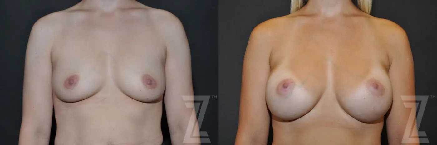 Austin 6 Months After Breast Augmentation in Austin, TX Before & After by Dr. Rocco Piazza - The Piazza Center