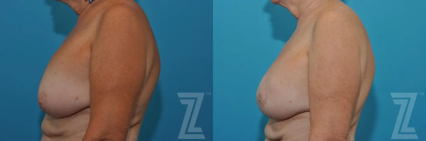 Austin Breast Augmentation Revision Before & After Gallery - Patient 132886586 - Image 3 - The Piazza Center
