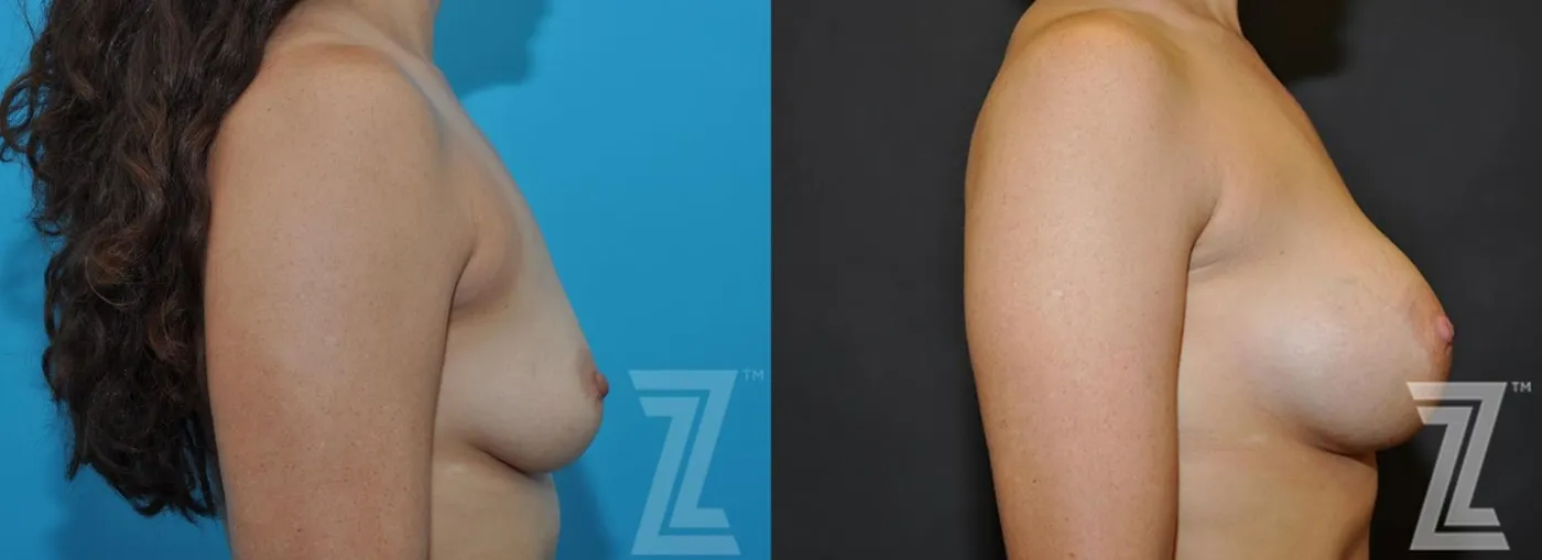 Austin Side View before & after images of 33 year old woman with breast augmentation - The Piazza Center - The Piazza Center