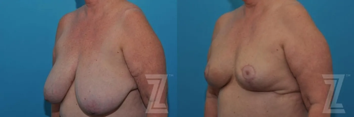 Austin Breast Reduction Before & After Gallery - Patient 132886611 - Image 2 - The Piazza Center