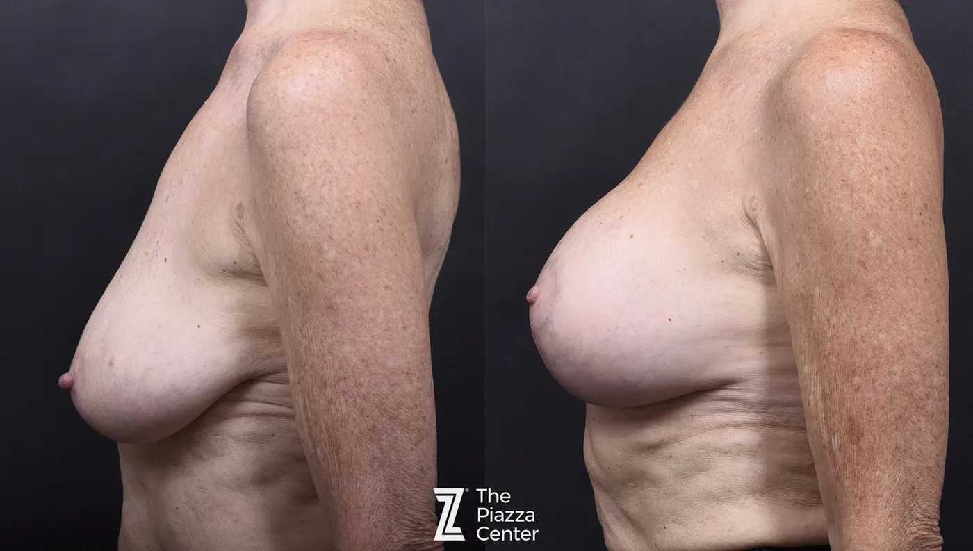 Austin Breast Augmentation Before & After Gallery - Patient 287263 - Image 5 - The Piazza Center