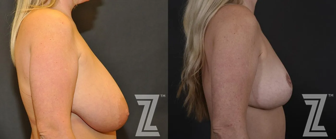 Austin Breast Reduction Before & After Gallery - Patient 132886746 - Image 5 - The Piazza Center