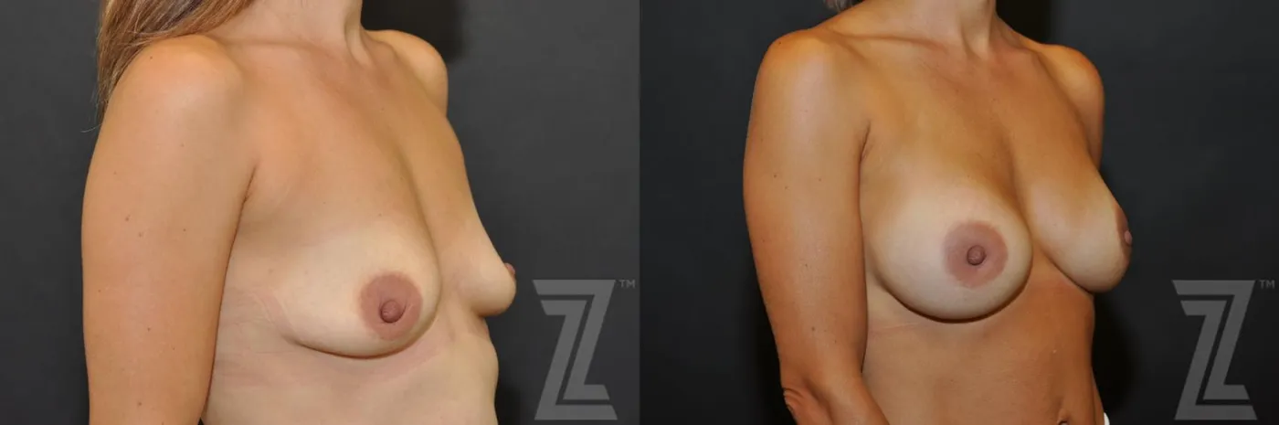Austin oblique view before and after image of 36-year-old mother of four breast augmentation at the piazza center - The Piazza Center