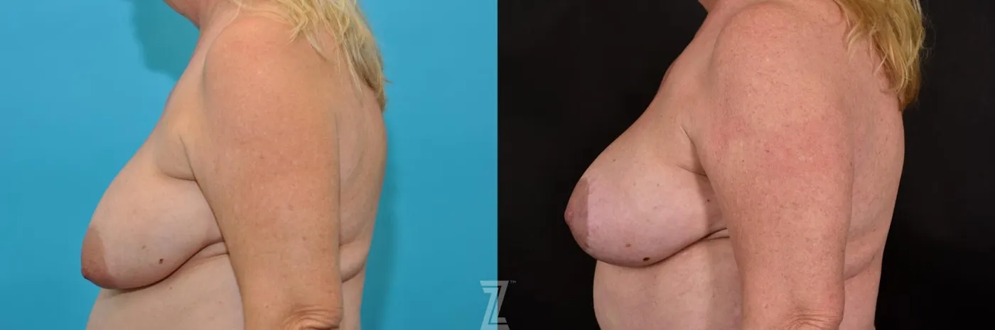 Austin Breast Lift Before & After Gallery - Patient 132791071 - Image 3 - The Piazza Center