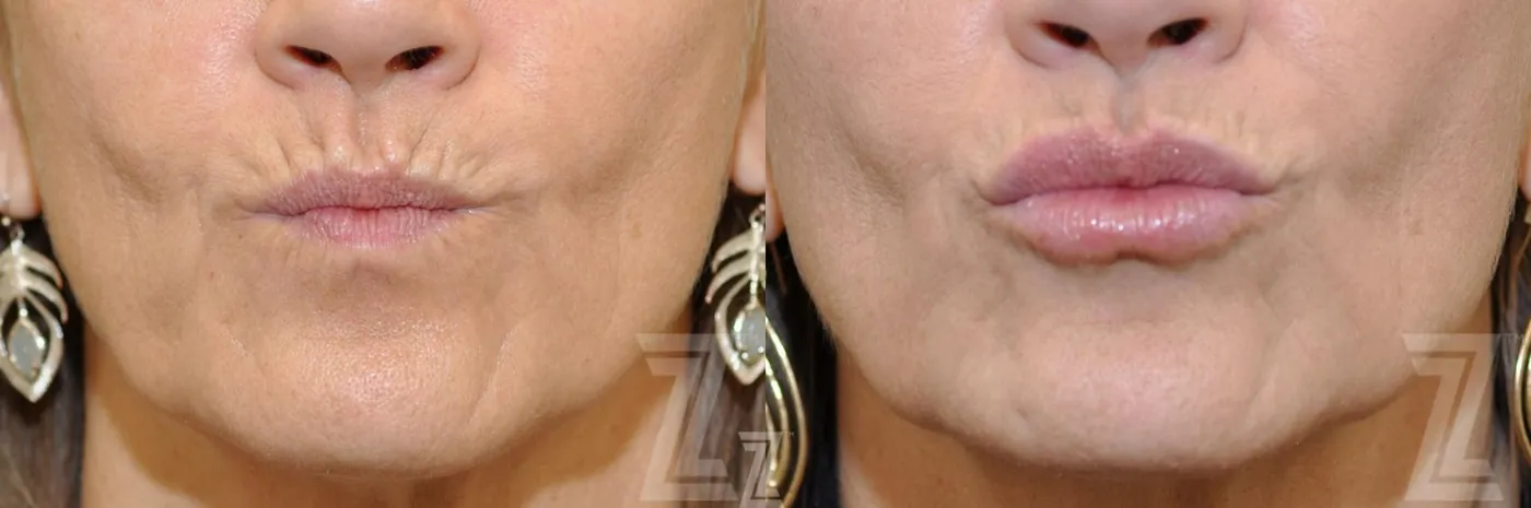 Austin Injectable Fillers Before & After Gallery - Patient 132963127 - Image 2 - The Piazza Center