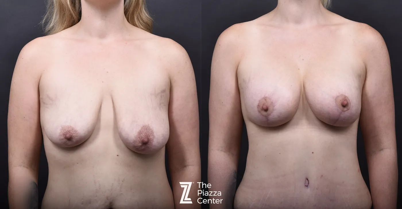 Austin Breast Augmentation With a Breast Lift Before & After Gallery - Patient 413161 - Image 1 - The Piazza Center
