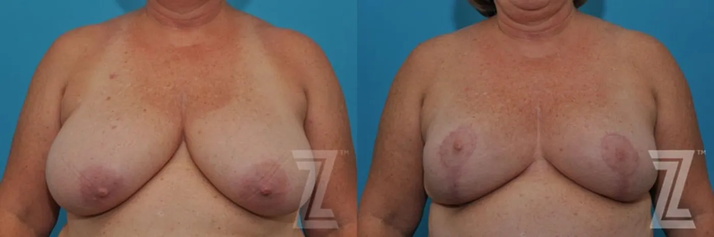 Austin Breast Reduction Before & After Gallery - Patient 132886617 - Image 1 - The Piazza Center