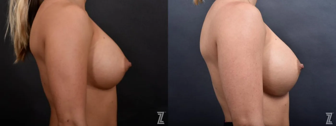 Austin Breast Augmentation Revision Before & After Gallery - Patient 132880910 - Image 5 - The Piazza Center