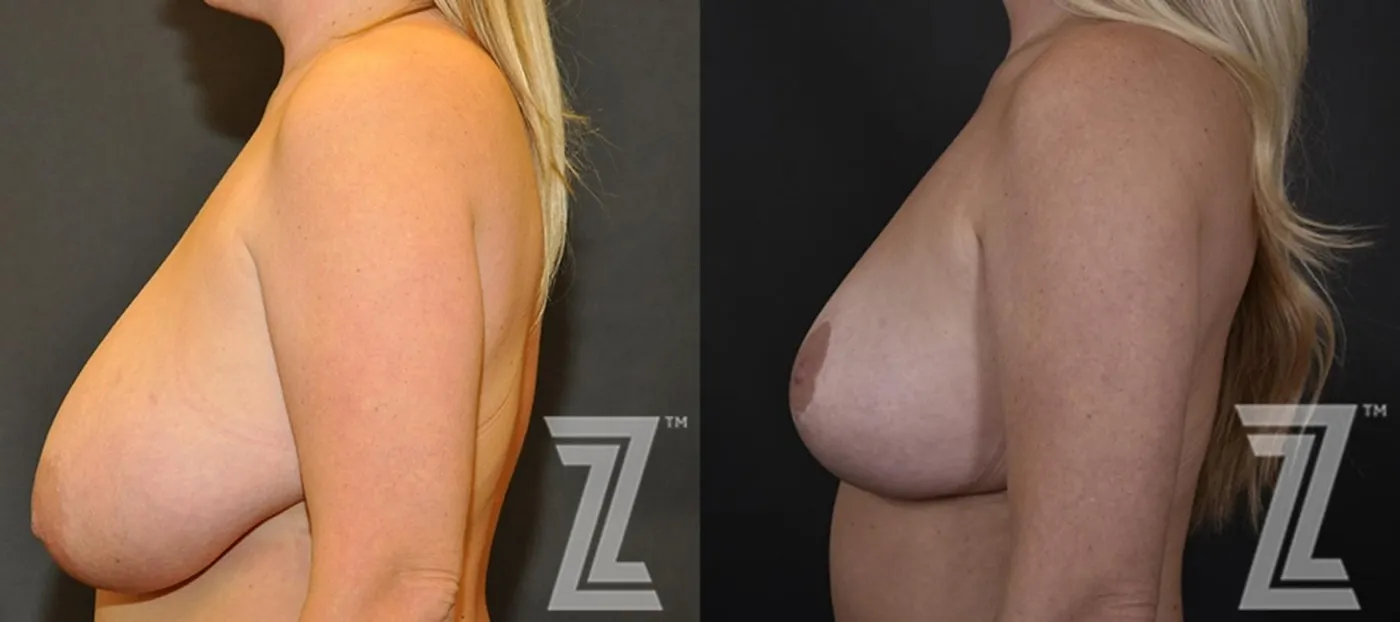 Austin Breast Reduction Before & After Gallery - Patient 132886746 - Image 3 - The Piazza Center