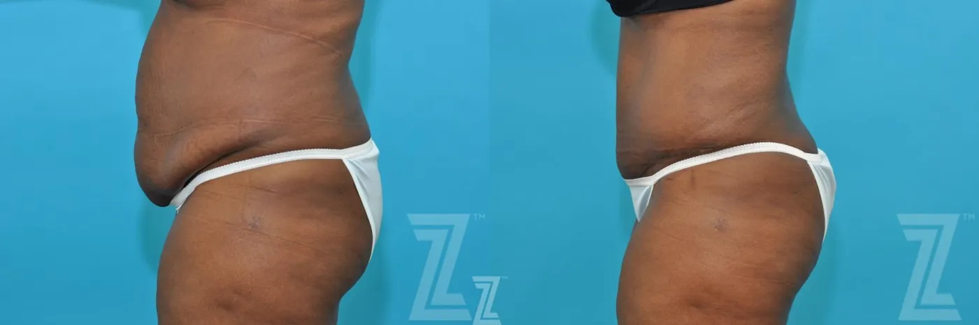 Austin Liposuction Before & After Gallery - Patient 132887164 - Image 2 - The Piazza Center