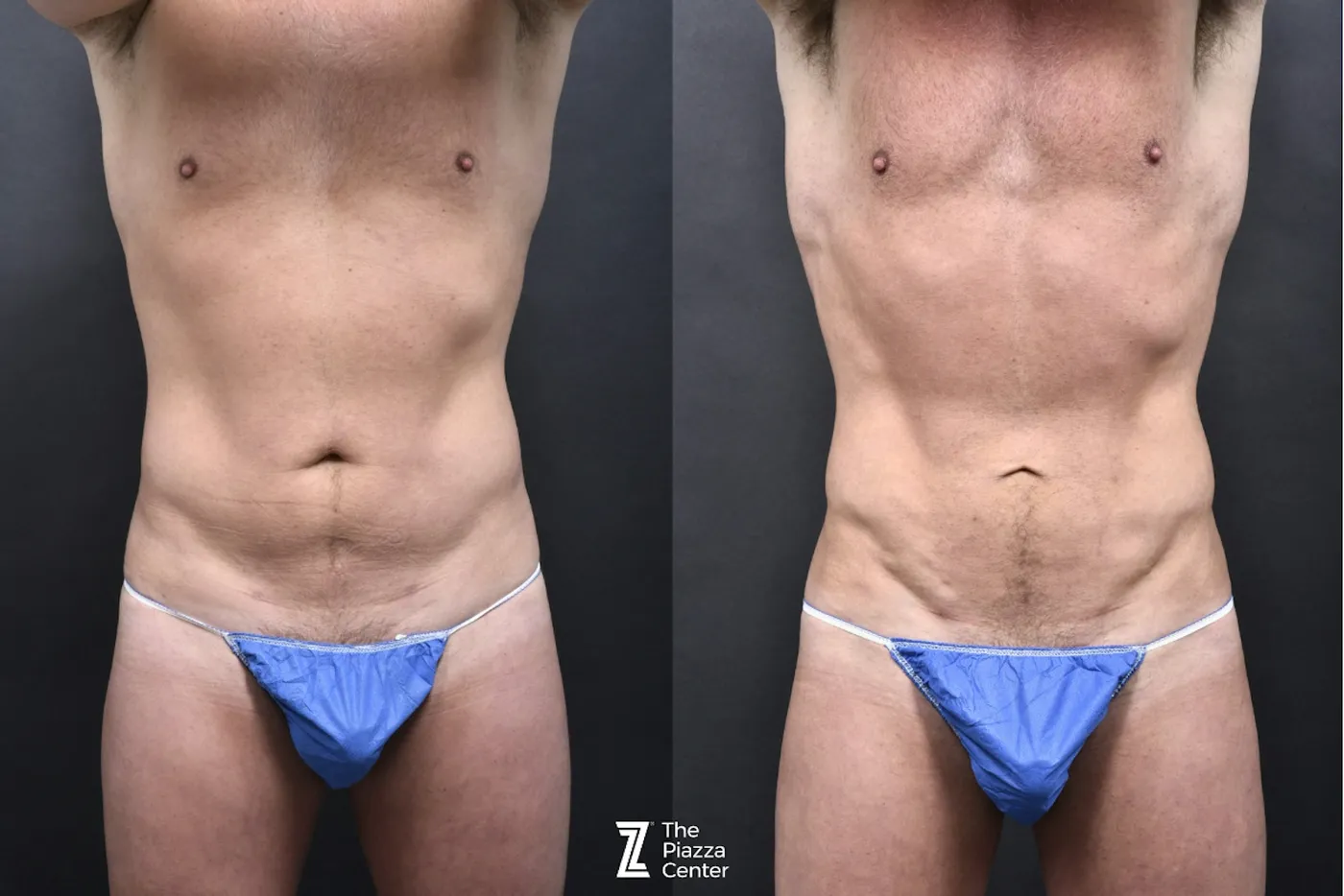 Austin Liposuction Before & After Gallery - Patient 355670 - Image 2 - The Piazza Center