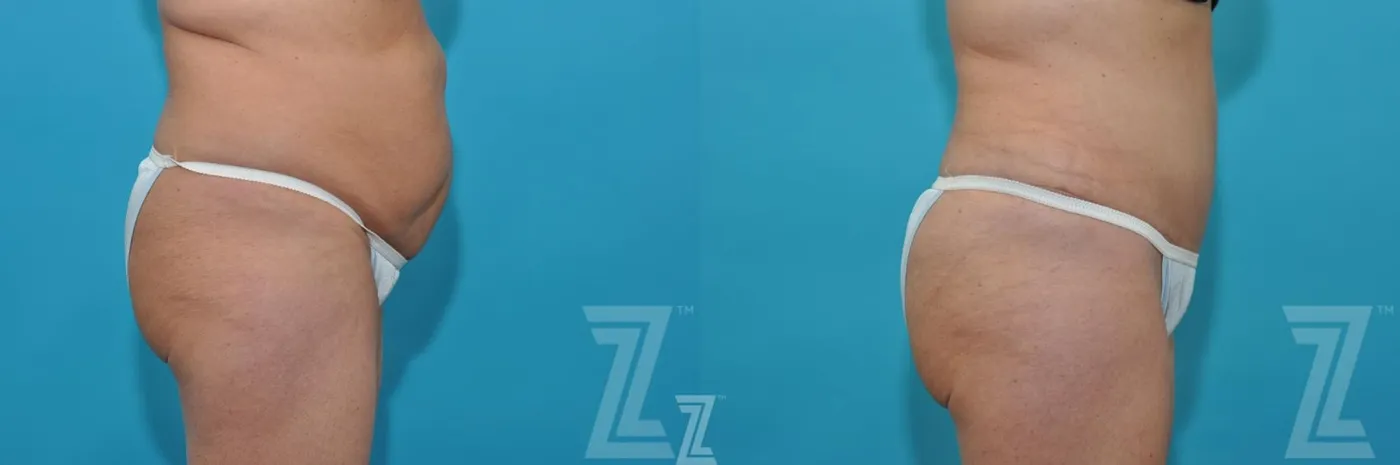 Austin Liposuction Before & After Gallery - Patient 132887306 - Image 4 - The Piazza Center