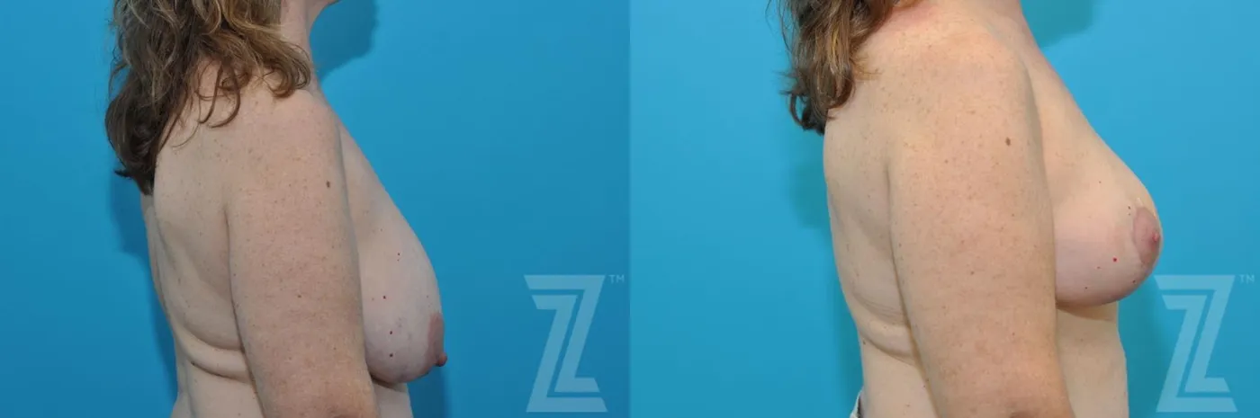 Austin Breast Reduction Before & After Gallery - Patient 132886744 - Image 5 - The Piazza Center
