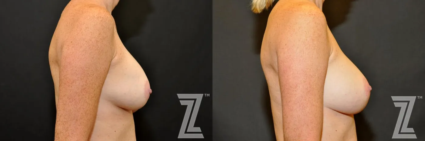 Austin Breast Augmentation Revision Before & After Gallery - Patient 132886587 - Image 5 - The Piazza Center