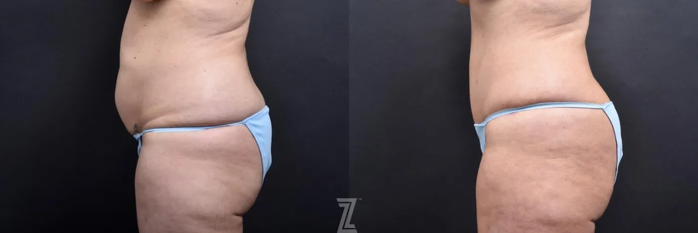 Austin Side View from Mommy Makeover of 41 year old woman in Austin, TX by Dr. Rocco Piazza - Before & After - The Piazza Center