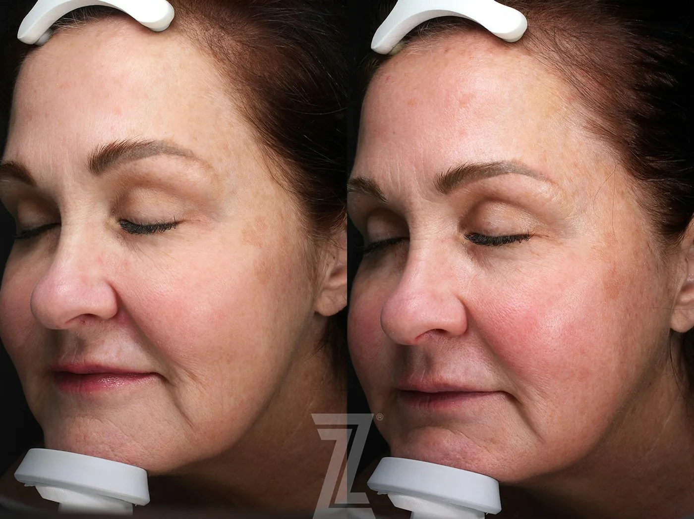 Austin HALO Before & After Gallery - Patient 367769 - Image 3 - The Piazza Center