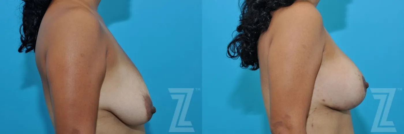 Austin Breast Augmentation With a Breast Lift Before & After Gallery - Patient 132791096 - Image 5 - The Piazza Center