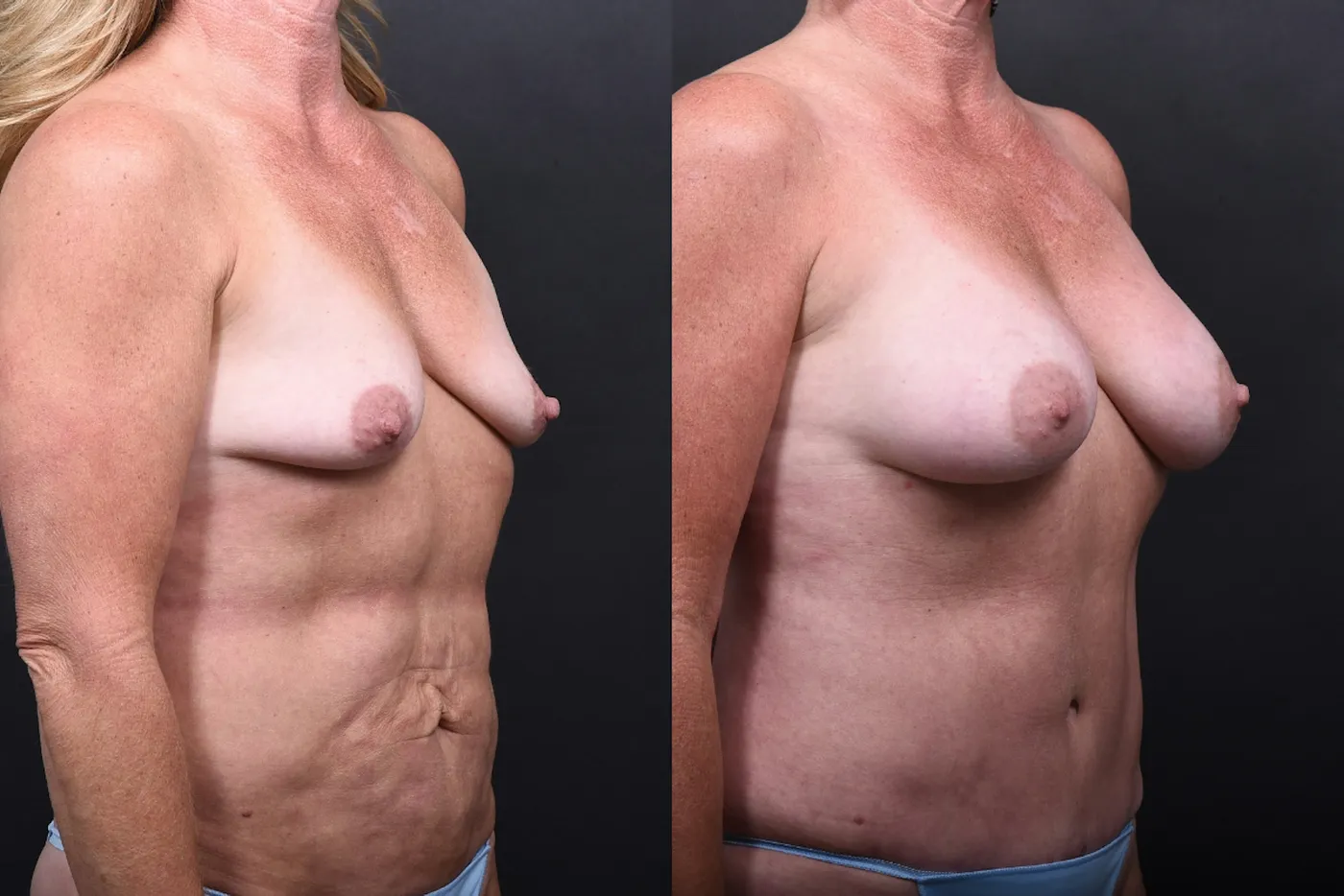 Austin Mommy Makeover Before & After Gallery - Patient 132903363 - Image 2 - The Piazza Center