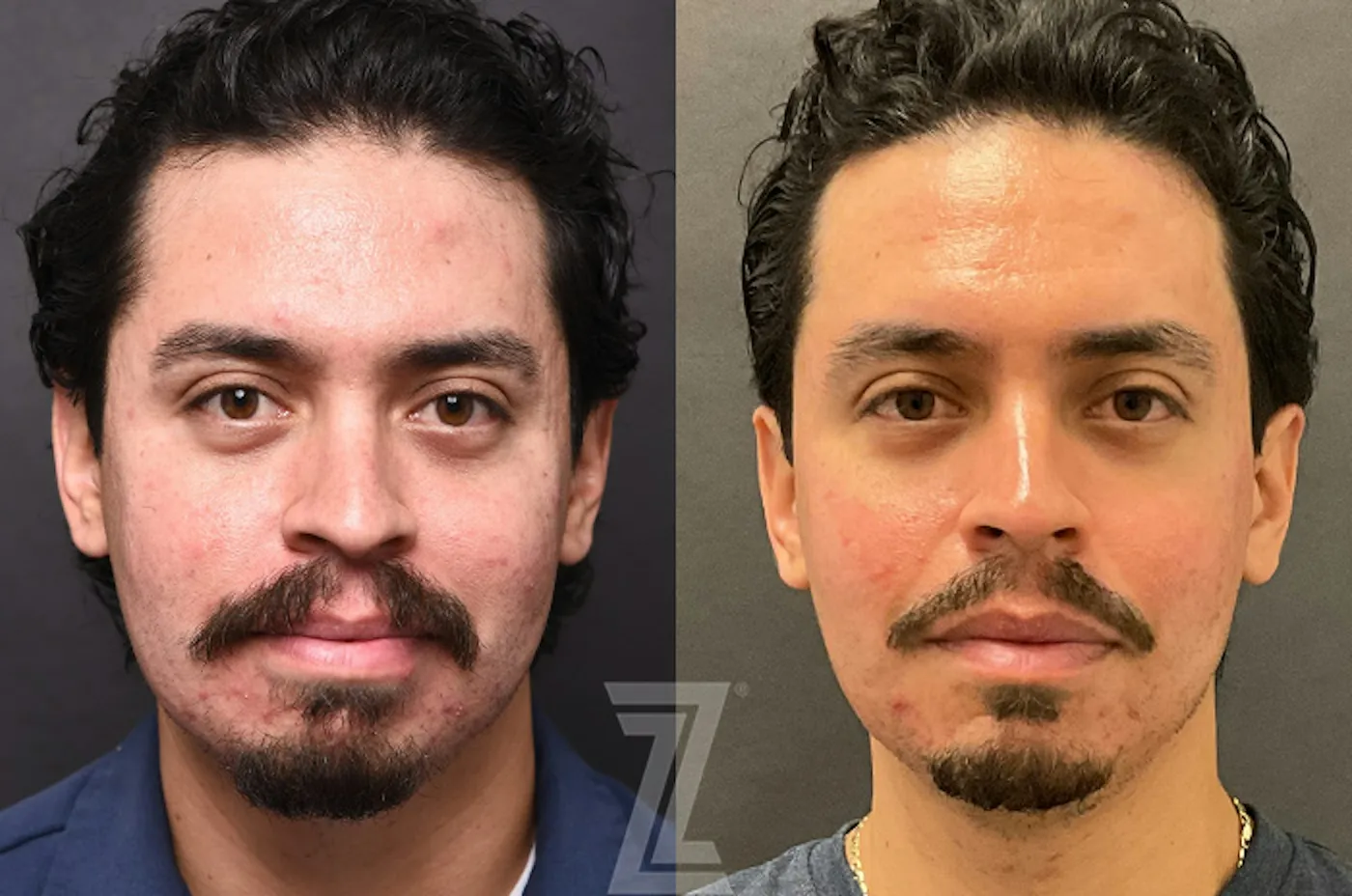 Austin Clear Skin Protocol Before & After Gallery - Patient 279974 - Image 1 - The Piazza Center