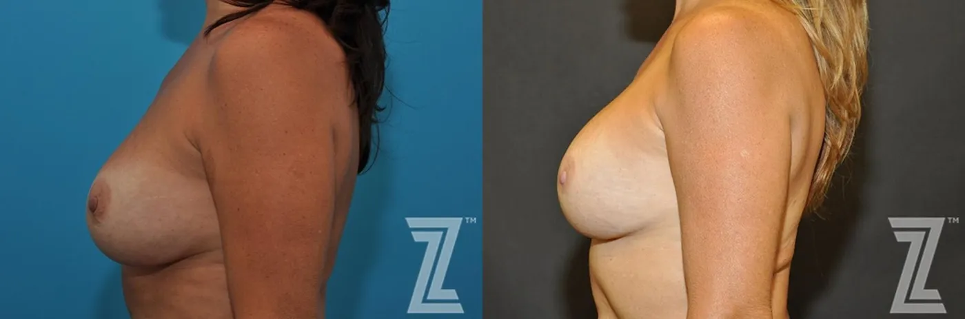 Austin Breast Augmentation Revision Before & After Gallery - Patient 132886563 - Image 3 - The Piazza Center