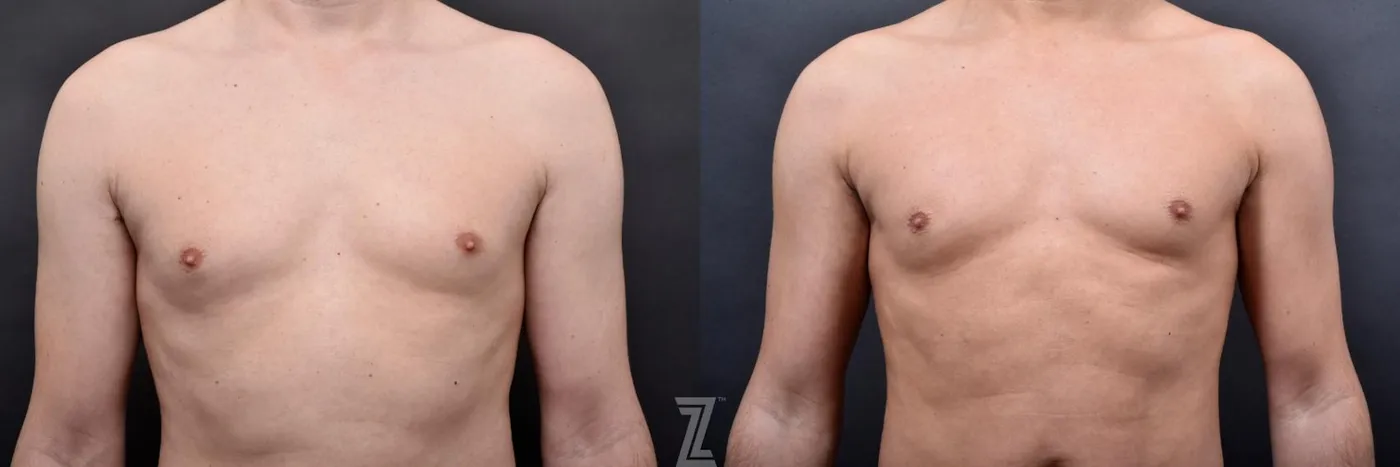 Austin Liposuction Before & After Gallery - Patient 132886947 - Image 4 - The Piazza Center