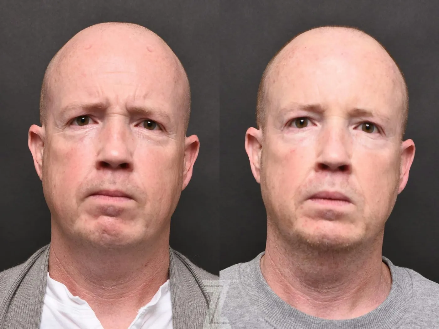 Austin Wrinkle Relaxers Before & After Gallery - Patient 132906313 - Image 2 - The Piazza Center