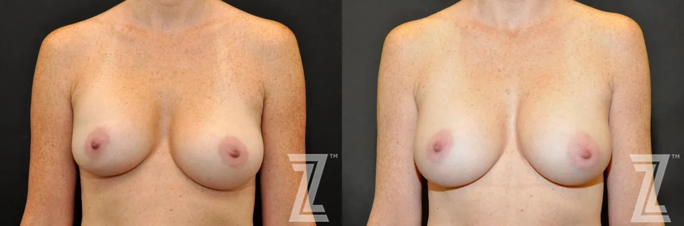 Austin Breast Augmentation Revision Before & After Gallery - Patient 132886587 - Image 1 - The Piazza Center