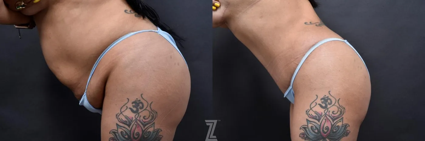 Austin Lateral Abdomen View in Flexion 6 Month Post-OP Mommy Makeover in Austin, TX by Dr. Rocco Piazza - The Piazza Center
