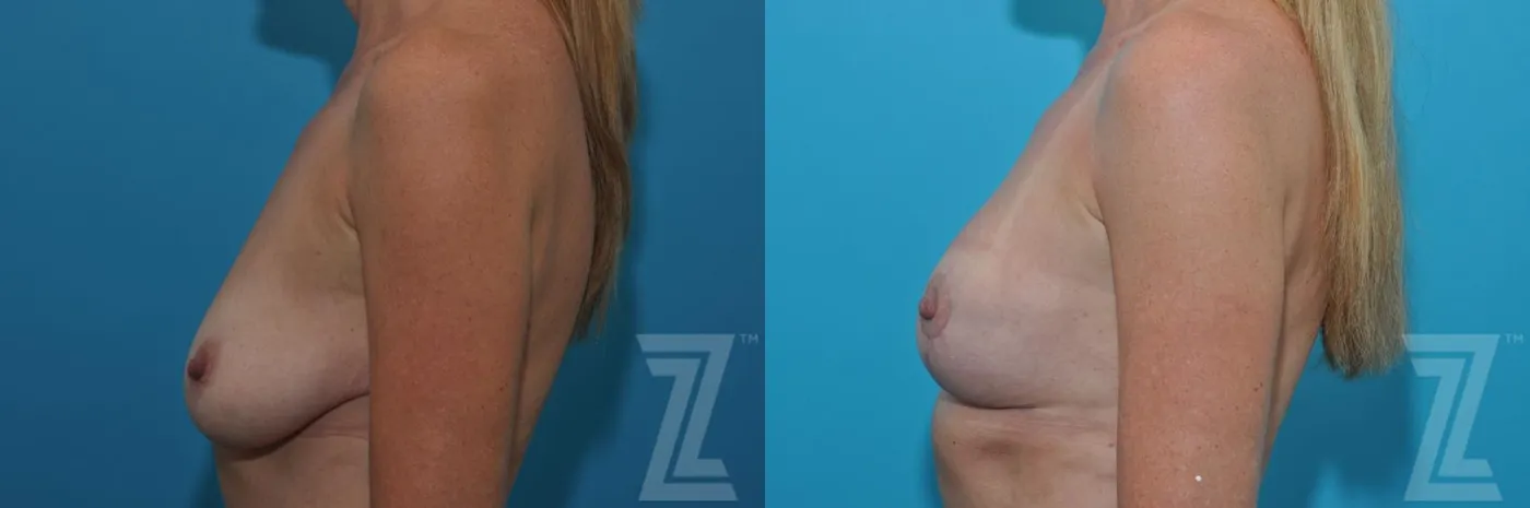 Austin Breast Lift Before & After Gallery - Patient 132791081 - Image 3 - The Piazza Center