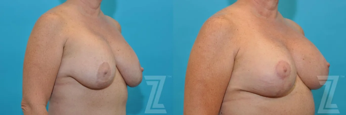 Austin Breast Augmentation Revision Before & After Gallery - Patient 132886540 - Image 4 - The Piazza Center