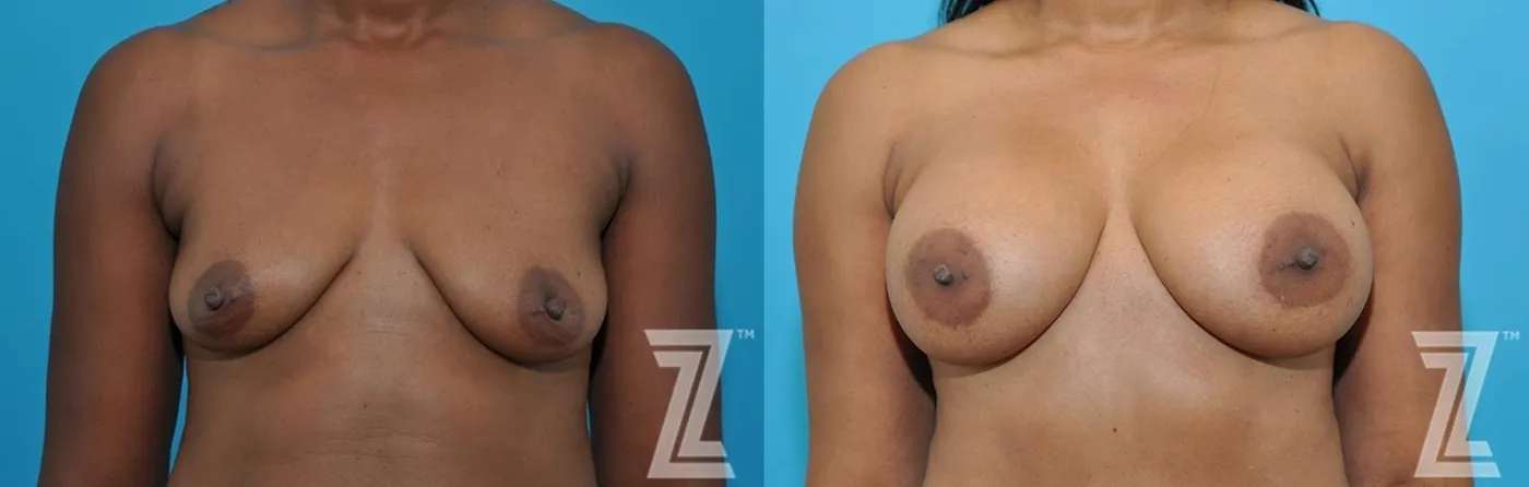 Austin Frontal breast view of 43-year-old mother of two mommy maker over - Dr. Rocco Piazza - The Piazza Center