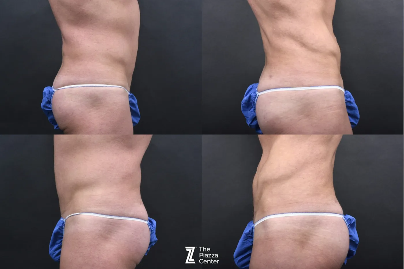 Austin Liposuction Before & After Gallery - Patient 355670 - Image 8 - The Piazza Center