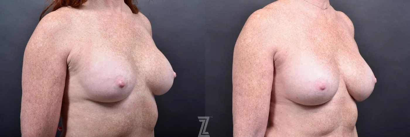 Austin Breast Augmentation Revision Before & After Gallery - Patient 132886568 - Image 4 - The Piazza Center