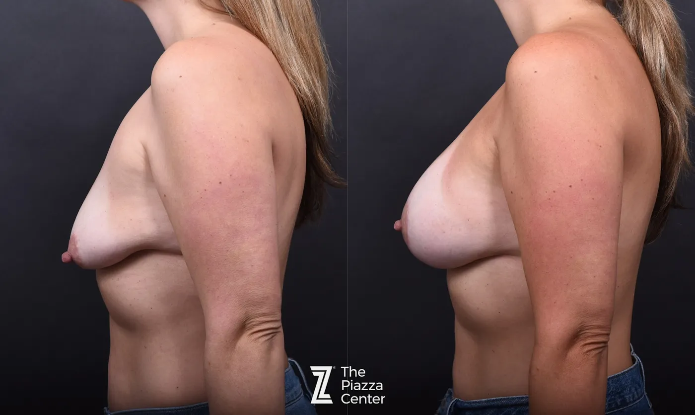 Austin Motiva Implants Before & After Gallery - Patient 311879 - Image 5 - The Piazza Center
