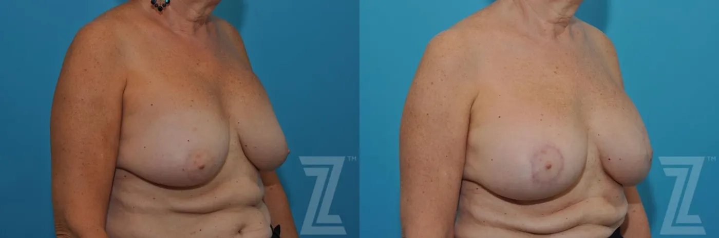 Austin Breast Augmentation Revision Before & After Gallery - Patient 132886586 - Image 4 - The Piazza Center