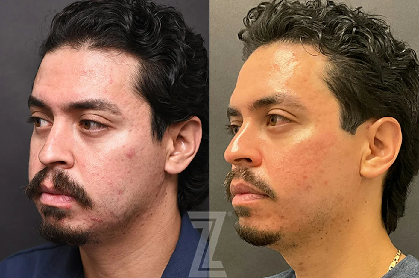 Austin Clear Skin Protocol Before & After Gallery - Patient 279974 - Image 4 - The Piazza Center