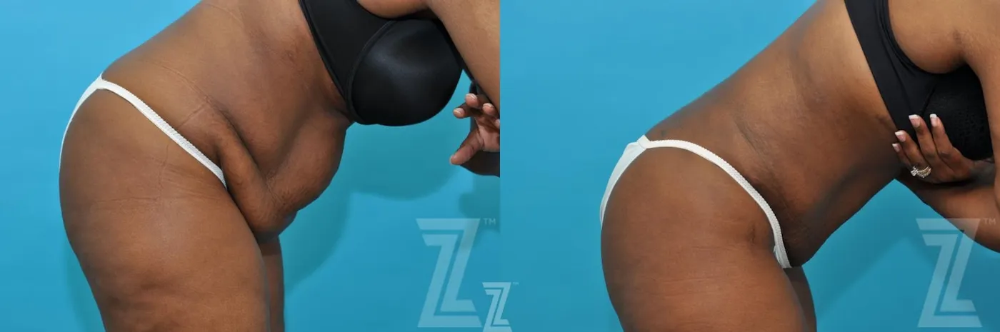 Austin Liposuction Before & After Gallery - Patient 132887164 - Image 5 - The Piazza Center