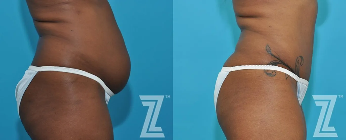 Austin Side Abdomen view of 43-year-old mother of two mommy maker over - Dr. Rocco Piazza - The Piazza Center