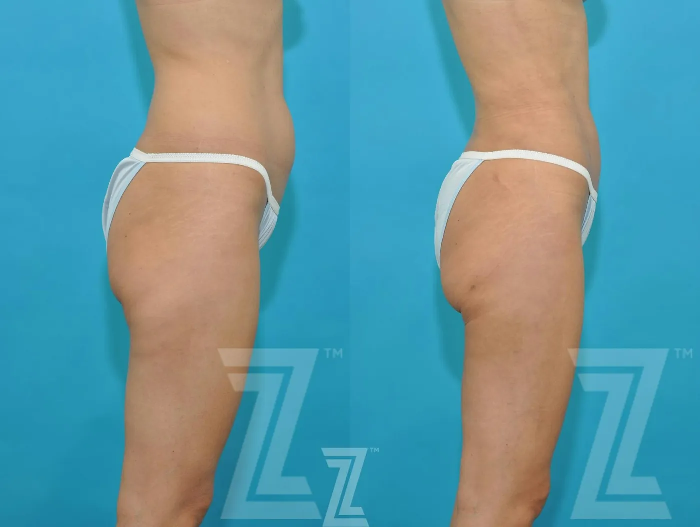 Austin Liposuction Before & After Gallery - Patient 132893822 - Image 4 - The Piazza Center