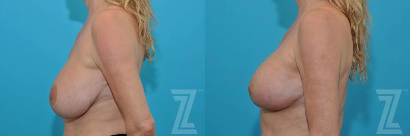 Austin Breast Augmentation Revision Before & After Gallery - Patient 132886579 - Image 3 - The Piazza Center