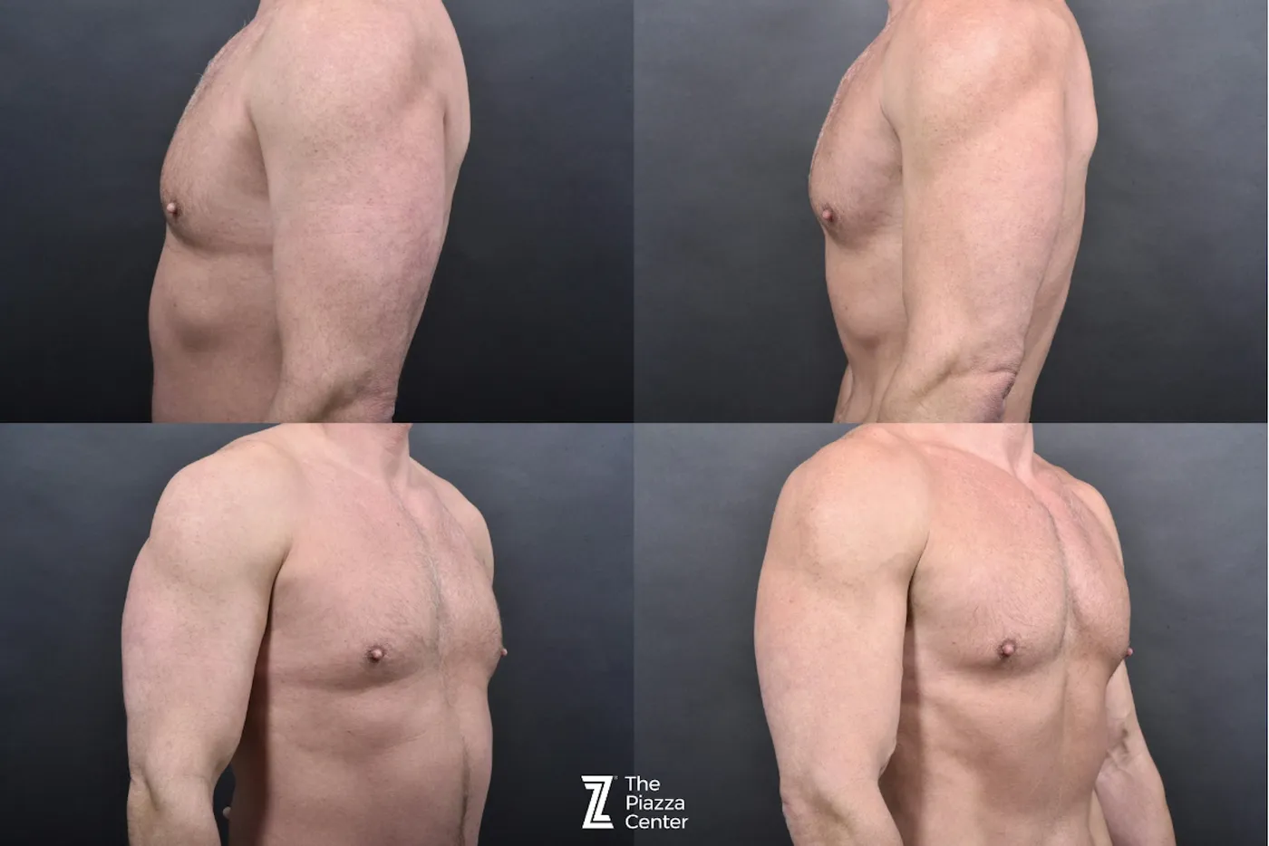 Austin Liposuction Before & After Gallery - Patient 355670 - Image 6 - The Piazza Center